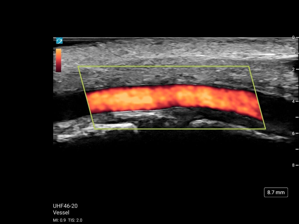 lx uhf46 20 vessel peds dorsalis pedis artery long power (1)