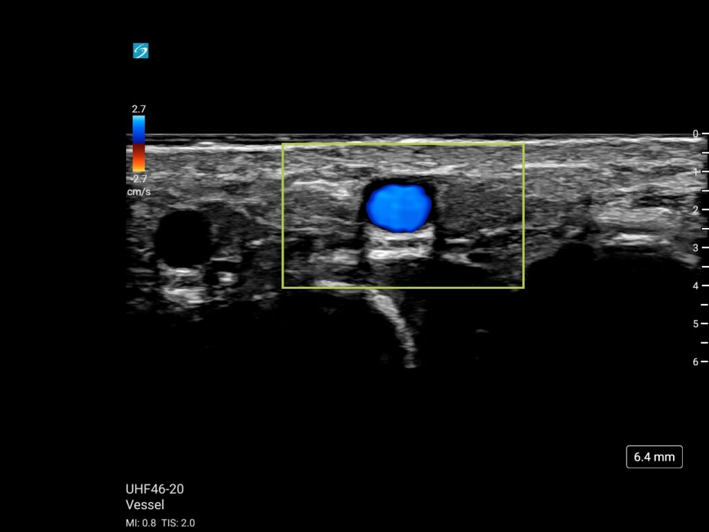 lx uhf46 20 vessel peds hand vein dorsal aspect trv color