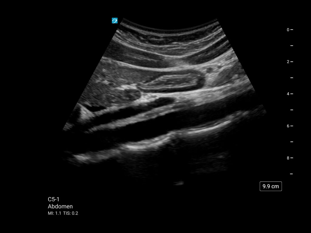 Sonosite ST mt c5 1 abdomen gastric contents 2