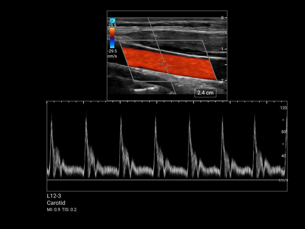 mt l12 3 carotid cca pw trace