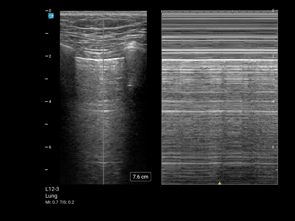 mt l12 3 lung m mode