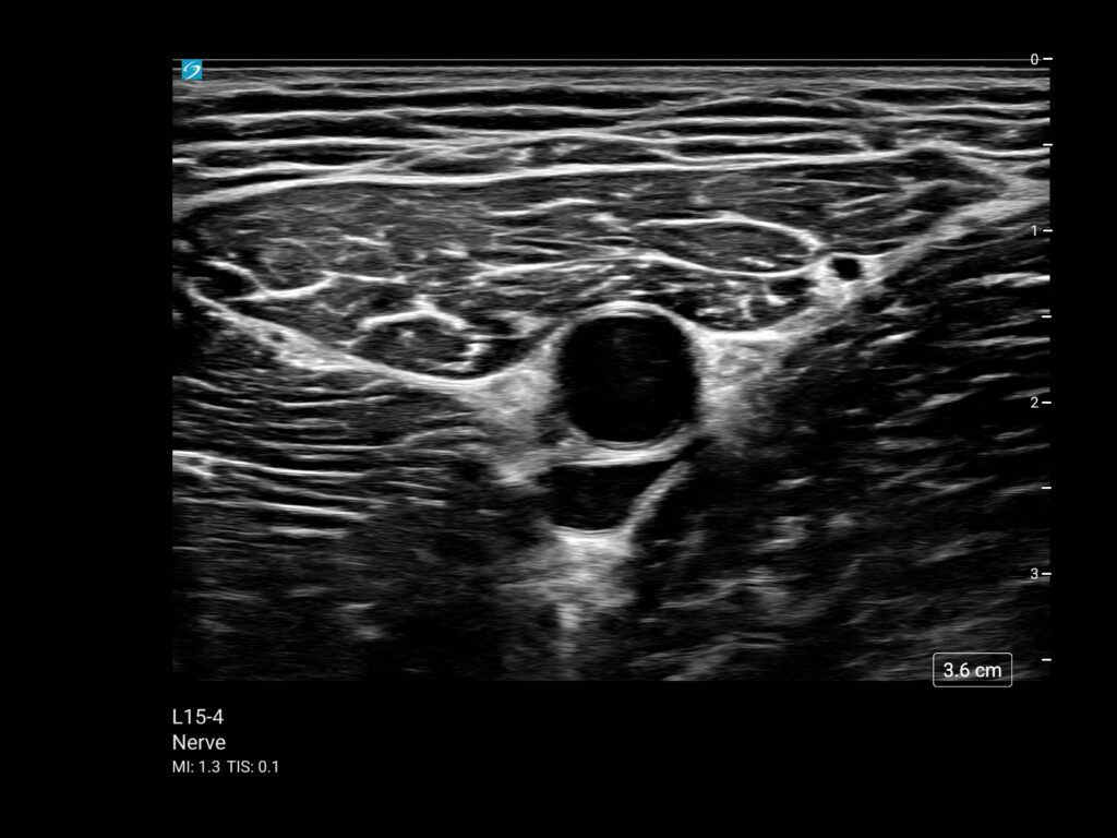 Sonosite ST mt l15 4 nerve adductor canal
