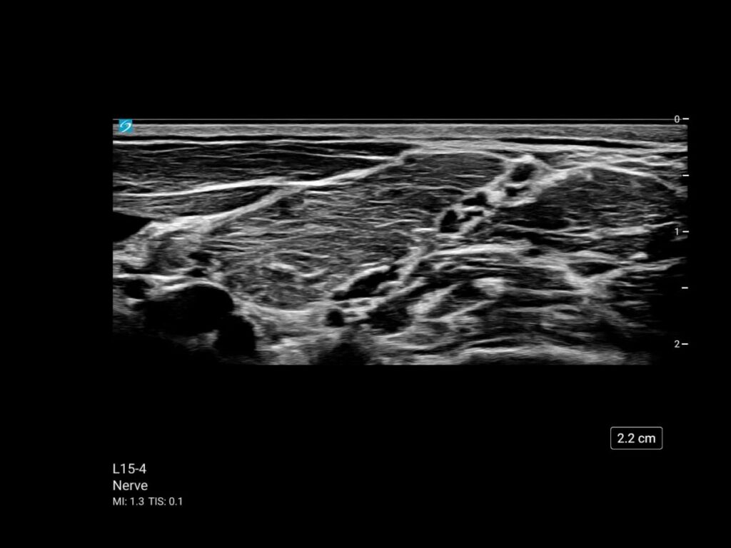 Sonosite ST mt l15 4 nerve brachial plexus interscalene contrast