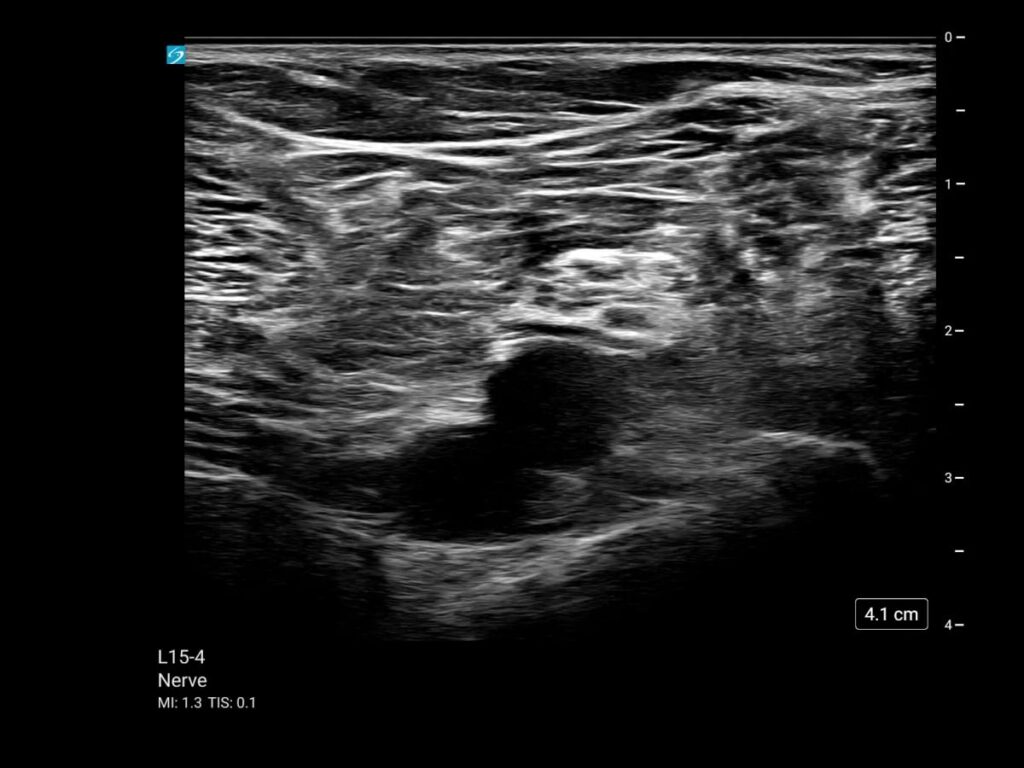 mt l15 4 nerve popliteal sciatic contrast 3