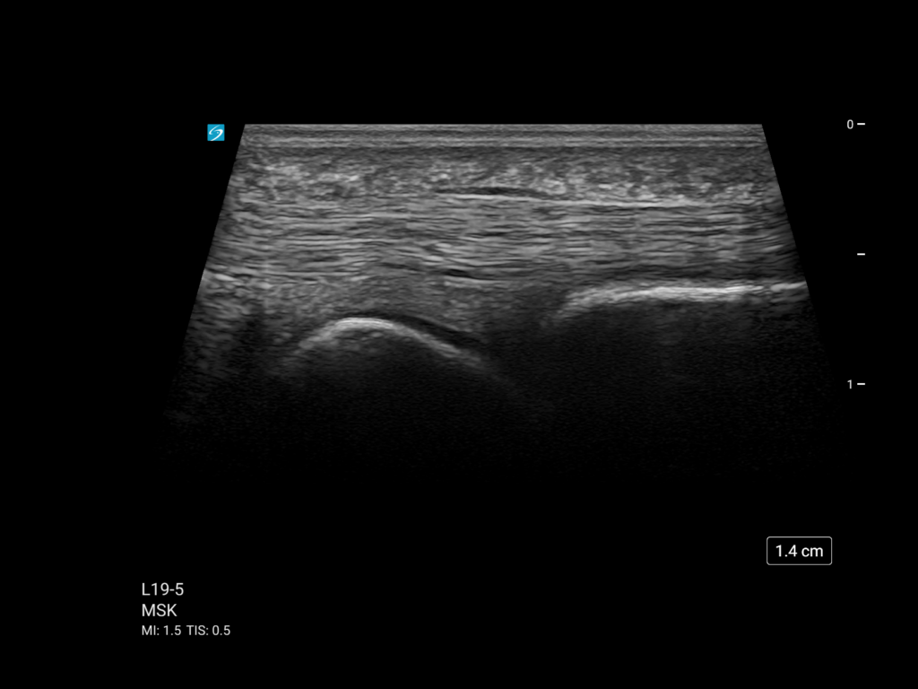 Sonosite ST MT L19 5 MSK Volar Hand 2nd Flexor Tendon Over MCP Trapezoid Clip Mp4 Image 1024x768