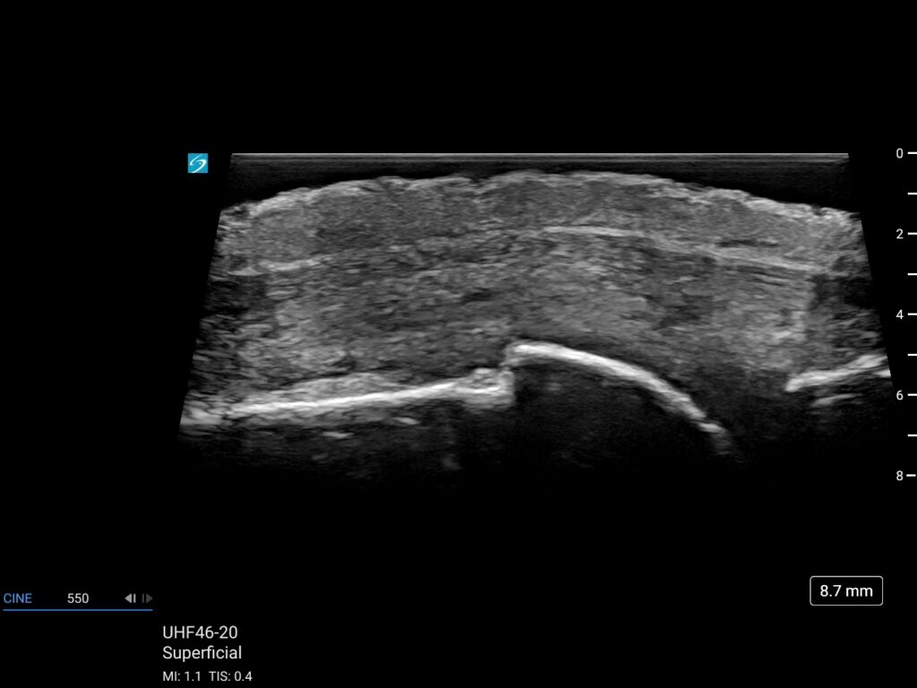 pair k lx uhf46 20 superficial dorsal mcp joint long axis joint capsule with good metacarpal notch