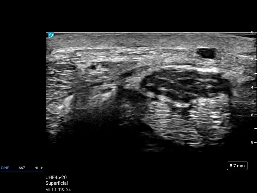 pair n lx uhf46 20 superficial wrist palmar cutaneous branch of median nerve