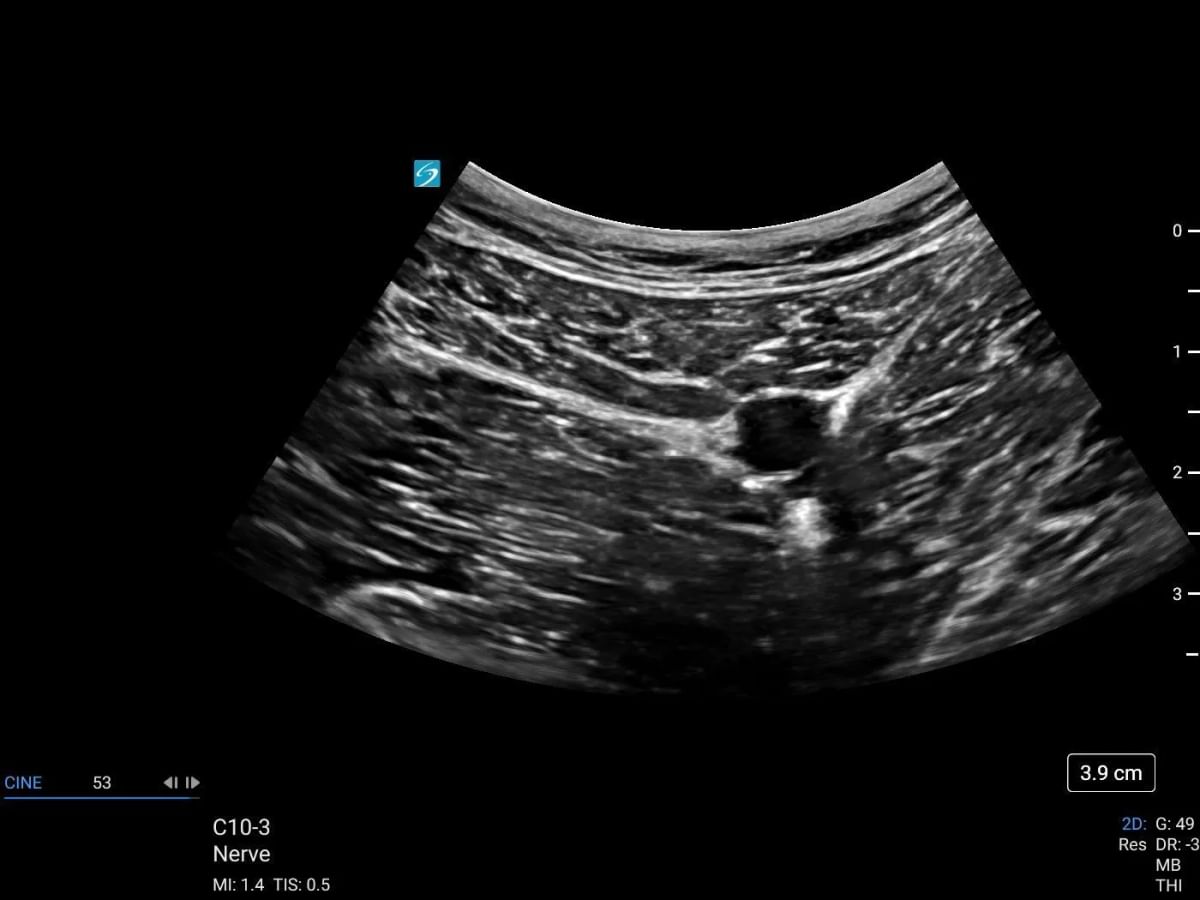 sonosite lx c10 3 nerve adductor canal block