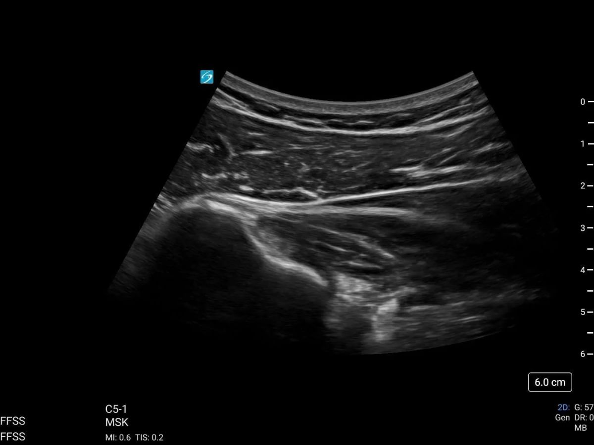 sonosite lx c5 1 msk shoulder teres minor tendon insertion