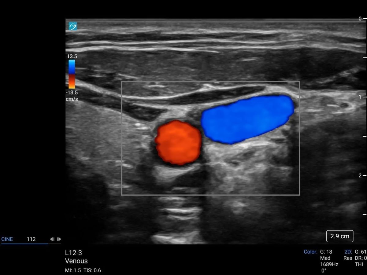 sonosite lx l12 3 venous ijv cvd