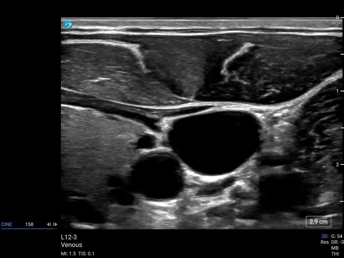 sonosite lx l12 3 venous right ijv central line access cephalad approach