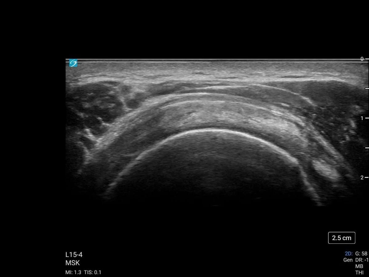 sonosite lx l15 4 msk shoulder rotator cuff transverse