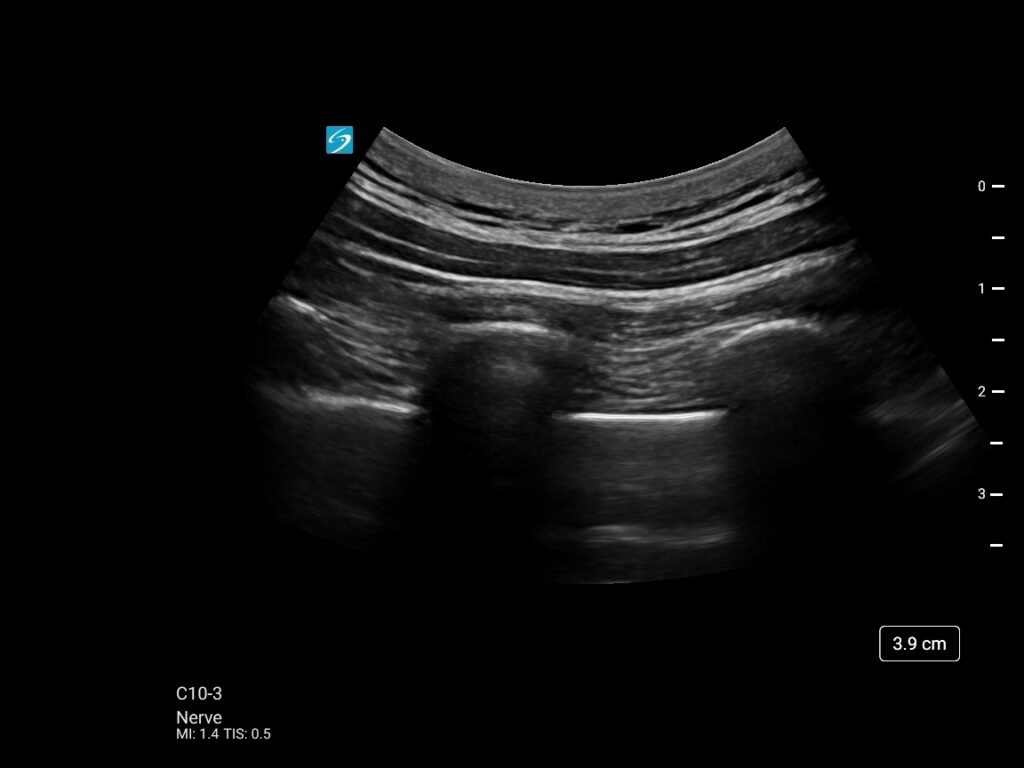 Sonosite ST st c10 3 nerve erector spinae 1