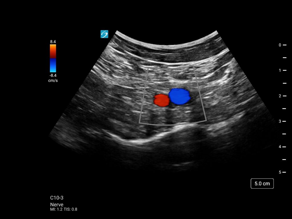 Sonosite ST st c10 3 nerve ipack posterior color