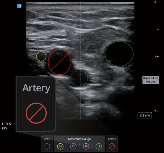 Less Stress, Every Time: Meet PIV Assist
